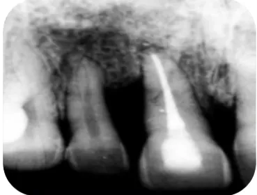 Fig 10. Radiograph Shows Extruded Central Incisor. 
