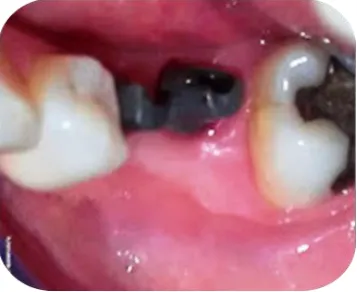 Figure 15: Acrylic Wedge Is Kept In Place  