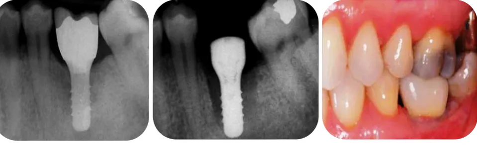Figure 21: Implant-Supported  Final Restoration 