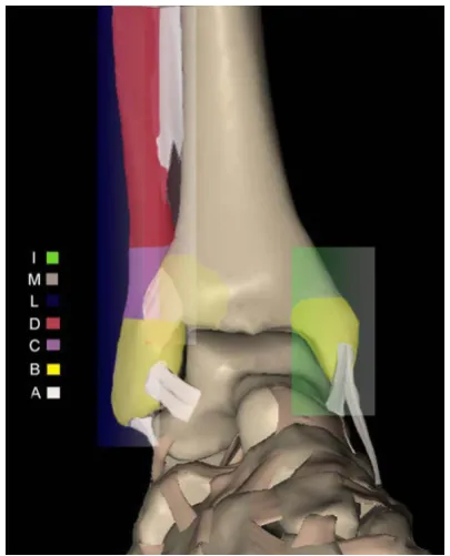Figure 1. Definition of the three columns of ankle fibular tibiofibular syndesmosis level (lateral C) and dial column consists of deltoid ligament (medial A) and medial malleolus (medial B) from far to near