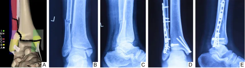 Figure 5. Fracture cases at lateral column D + middle column A + medial column B. Fracture diagram (A); using fixa-tion through lateral ankle approach + medial approach, preoperative anteroposterior (B) and lateral (C) radiographs; postoperative anteroposterior (D) and lateral (E) radiographs.