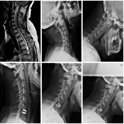 Figure 1. X-ray of typical patients before and after CDA at C6/7.