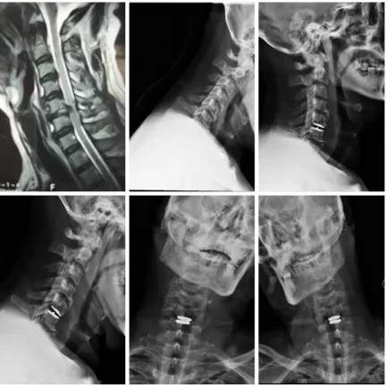 Figure 2. X-ray of typical patients before and after CDA at C5/6.