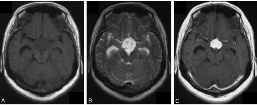 Figure 1. Pre-operative MRI. A. T1-weighted image. B. T2-weighted image. C. T1-weighted image with Gd-enhance-ment.