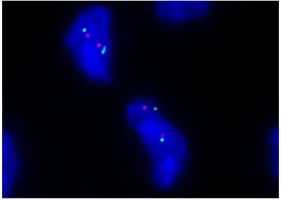 Figure 5. FISH analysis of the present case. KI-AA1549-BRAF fusion was lacking.