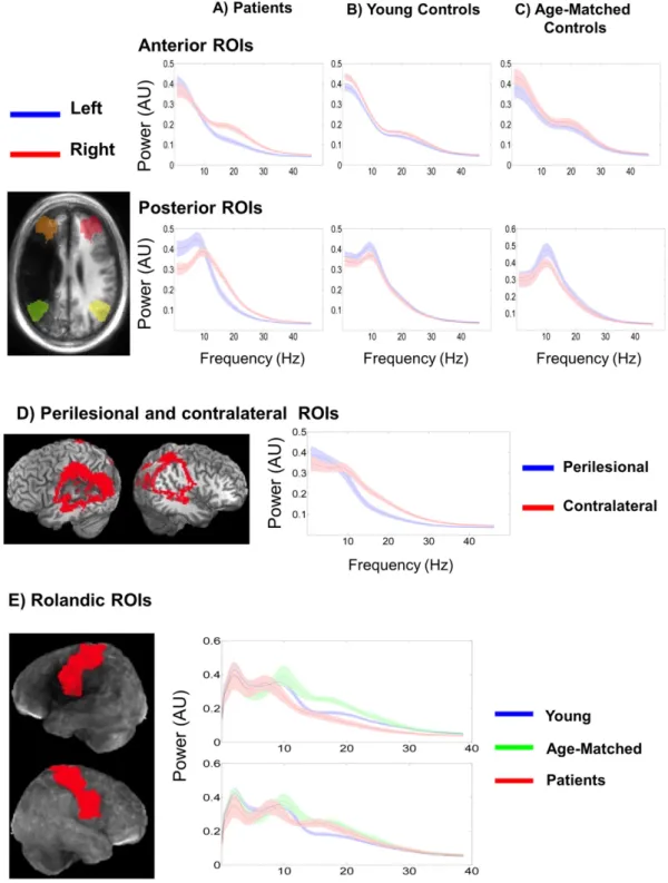 Table 2 presents correlations of MSE and relative band power across the entire cortex for controls and in the perilesional areas of  pa-tients
