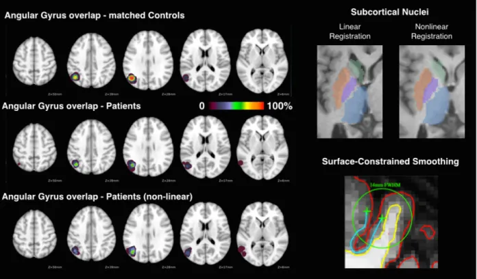 Figure 3-1 Nonlinear registration and surface-based tools improve stroke patient alignment