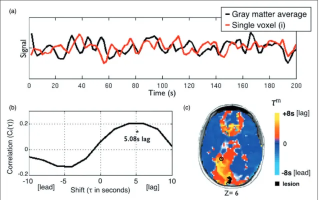Figure 1. Using temporal cross-correlation to measure lag in resting state fMRI. (a) The global reference signal (black line, top panel) is measured by averaging all non-lesioned gray matter voxels
