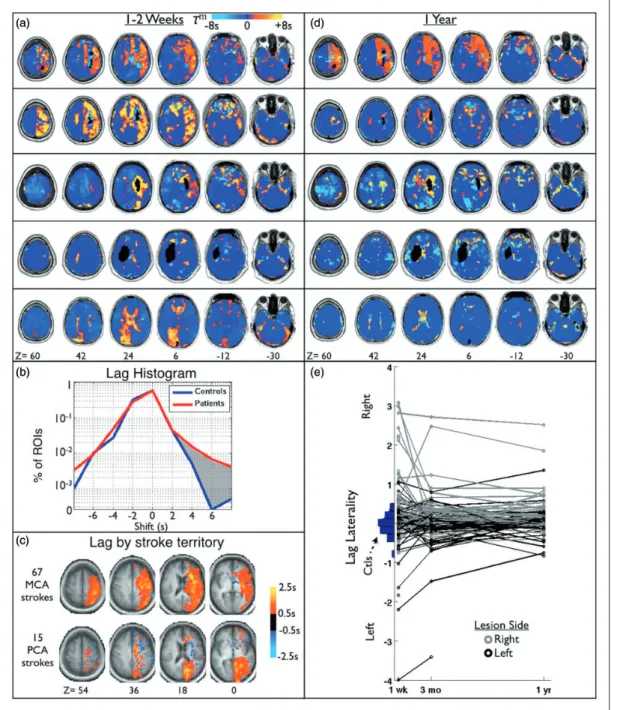 Figure 3 shows regional lag in stroke patients relative to regional cerebral blood ﬂow (rCBF) and lag laterality relative to internal carotid artery occlusion