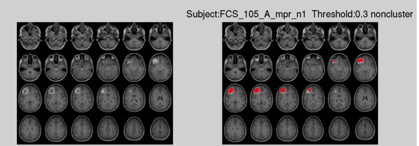 Figure 1.2 shows the result using a default threshold, which in this case leads to incomplete lesion 