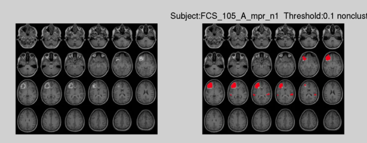 Figure 1.5 (a) Non-clustering result at threshold T = 0.1 for stroke patient 105 for T1 image 