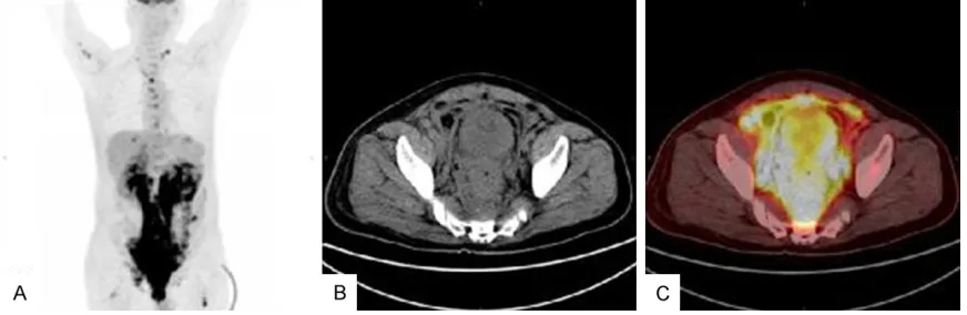 Figure 1. FDG-PET/CT images. A. FDG-PET reveals multiple swollen lymph nodes and FDG accumulation in the abdominal pelvic peritoneum (standardized uptake value; SUVmax 19.9)