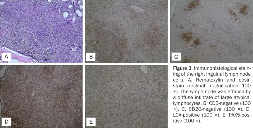Figure 2. Flow cytometry (immunophenotype) analysis of bone marrow cells. The cells were positive for CD10, CD19 and CD22 and negative for CD20 expression.