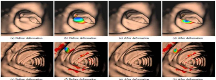 Figure 1: The candidate detection method applies a non-linear ’flattening’ operationto the colon wall
