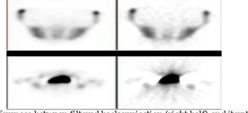 Figure 1:  Example showing differences between filtered back projection (right half) and iterative reconstruction method (left half)  