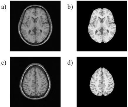 Figure 6. VOI extraction using 3D Skull Stripping: (a), (c) Original image. (b), (d) VOI  extracted image