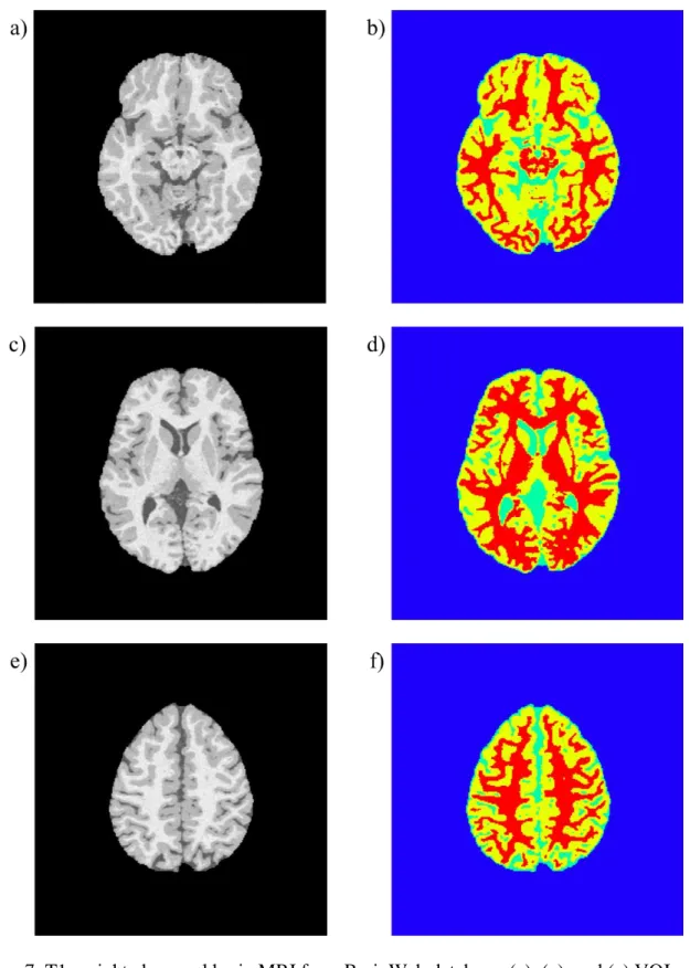 Figure 7. T1-weighted normal brain MRI from BrainWeb database: (a), (c), and (e) VOI  extracted original Image
