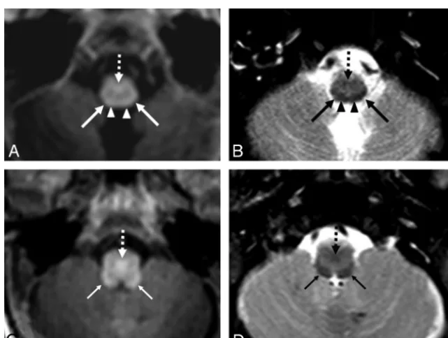 FIG 3. Comparison among GRE-T1WI (imaged at term-equivalent age (40 weeksThe DSCP was myelinated in all term-equivalent infants on both GRE-T1WI and SE-T2WI, while the brachium of the inferior colliculus was variablyA), SE-T1WI (B), and SE-T2WI (C) at the 