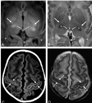 FIG 5. GRE-T1WI (Athe myelinated ventrolateral thalami (tions posteriorly (A and C) and SE-T2WI (B and D) in a very preterm infant (26 weeks �4 days) imaged at term-equivalent age (40 weeks �2 days)