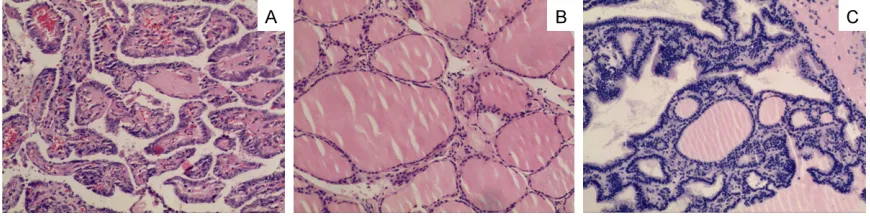 Figure 2. Representative HE staining results of conventional papillary thyroid carcinomas, pericarcinous tissue, and benign nodules