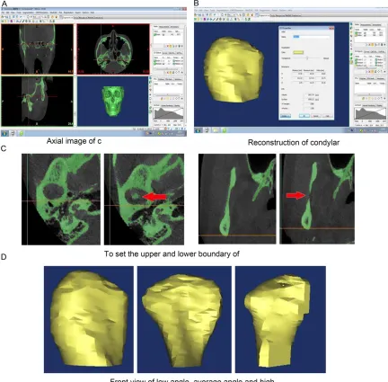 Figure 1. Reconstruction process of condylar volume and surface area. 