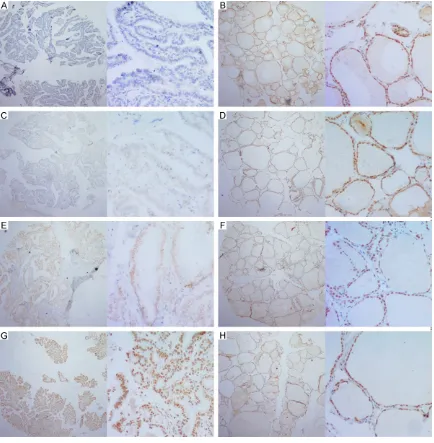 Figure 1. Representative immunohistochemical staining of SIRT7 in human thyroid carcinoma tissues