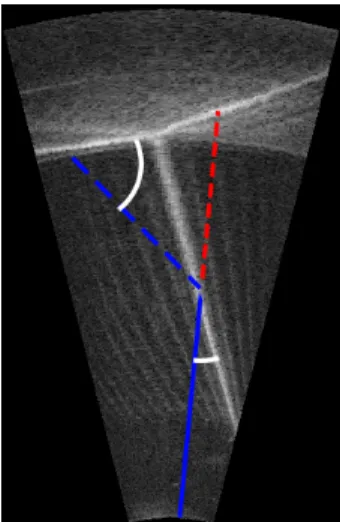 Figure 4-3: Artifact from a dual-path reflection. Actual sound path is shown in blue, with the solid line representing the primary path and the dashed line representing the path of the reflection