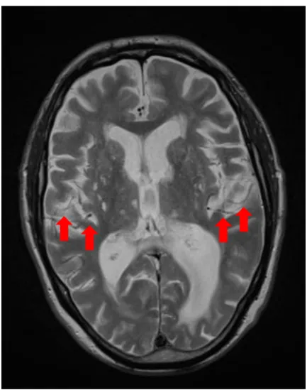 Figure 1. Axial section of patient HCM from a structural MRI scan (produced in 2008). This 