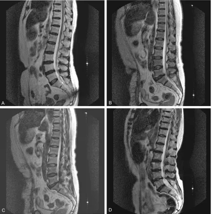 Figure 1. Diagram of the relation of Gln326, Trp326 and Arg326 with lumbar intervertebral disc degeneration MRI