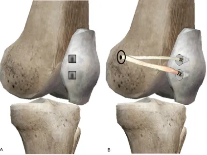 Figure 4. A. Two bony grooves with one drilled at the proximal medial border patella and the other drilled at the cen-tre medial patella, which were 0.5 cm*0.5 cm*0.5 cm in volume respectively