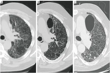 Figure 1. Progression of fibrosis on CT scans of the native lung of a 57-year-old male patient with IPF at (A) 11 months, (B) 36 months, and (C) 75 months post-SLT.