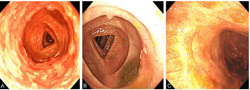 Table 3. Endoscopic assessments after anti-tuberculosis therapy