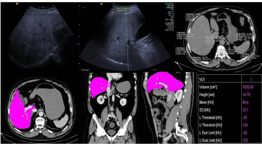 Figure 1. SWE, non-contrast CT images, and contrast CT MPR images. A 55-year old female case of the control group; LAI+13.2, the mean value of SWV 1.05 m/s, the liver volume 912.56 cm3, the liver size 13.2 cm