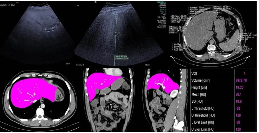 Figure 3. US, SWE, non-contrast CT images, and contrast CT MPR images. A 33-year old female patient, existing with grade 2 hepatosteatosis; LAI-21, the mean value of SWV 0.90 m/s, the liver volume 1975.91 cm3, the liver size 18.9 cm