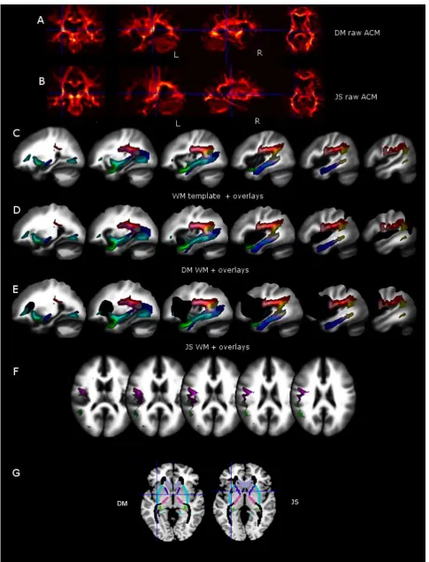 Figure 4: Panel A and B show the raw ACMs for each patient which reveal reduced anatomical connectivity within the left hemisphere for both patients