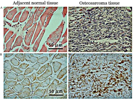 Figure 1. HE staining of and TAK1 expression in osteosarcoma and adjacent normal tissues (typical images).