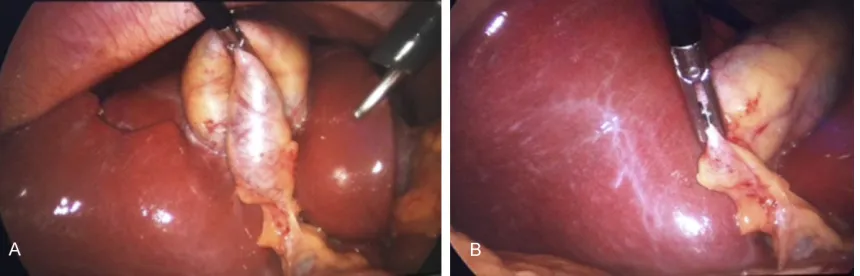 Figure 2. A. Traction of the gallbladder in 3-port cholecystectomy. B. Adequate traction of gallbladder with 2 instru-ments in 4-port cholecystectomy, clear visualization of the Calot’s triangle was maintained