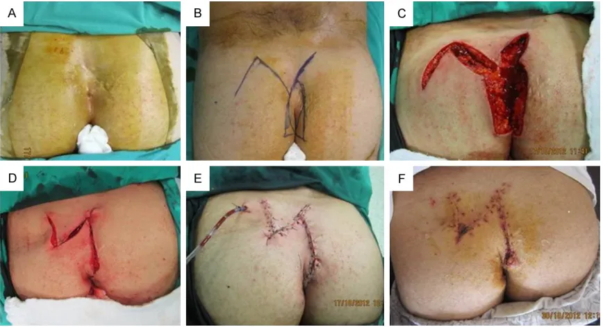 Figure 2. A 35-year old who had undergone two previous operations, He had been operated with excision and primary closure of the defect and the last one with the Limberg flap technique