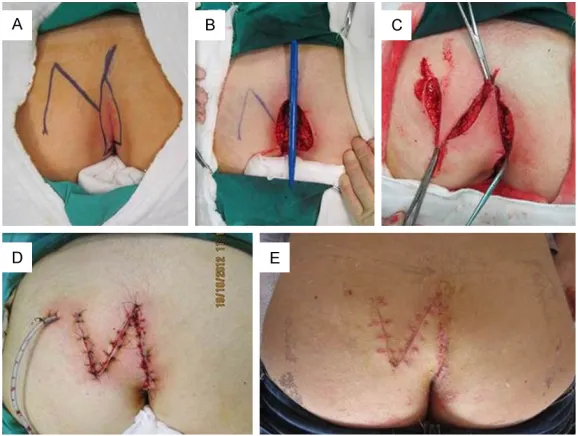 Figure 3. A 27-year old female patient operated on with the triangular flap technique