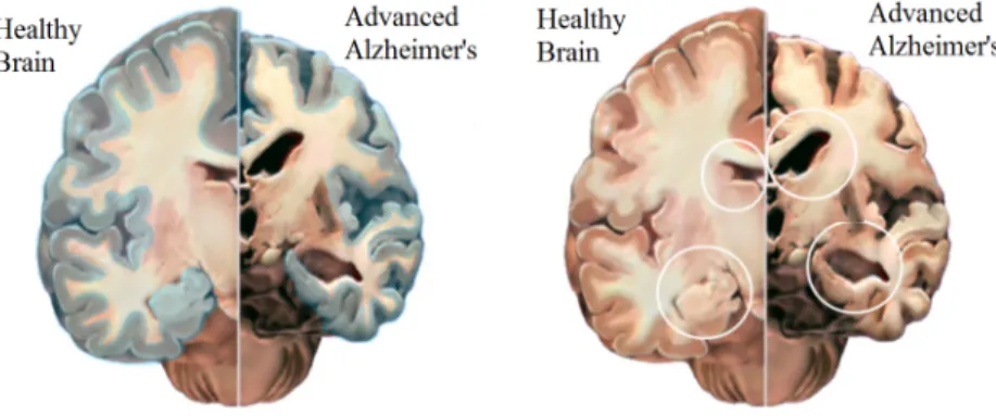 Figure 2.1: A crosswise slice through the middle of the brain between the ears. (Left) an overall shrinkage of the brain tissue