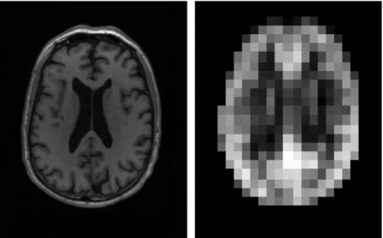 Figure 6.1: MRI Axial section before preprocessing (left) and after preprocessing (right) taken from an 84.9 years old cognitively normal man.