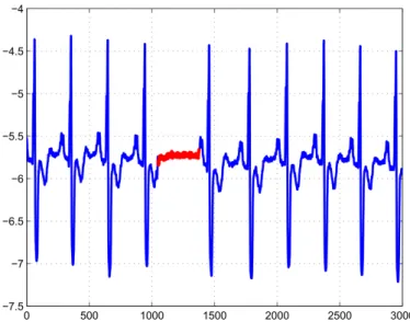 Figure 2.2: Example of one collective anomaly in a human electrocardiogram output time series dataset