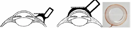 Figure 1: Contact lens with mirrors 