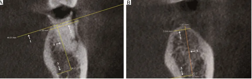 Figure 1. Measurement of the alveolar ridge width and height. A. Pre-extraction socket (tooth position 36; NG), with arrows indicating: (1) the ideal surface; (2) alveolar ridge width; (3) superior margin of the mandibular nerve canal; and (4) alveolar rid