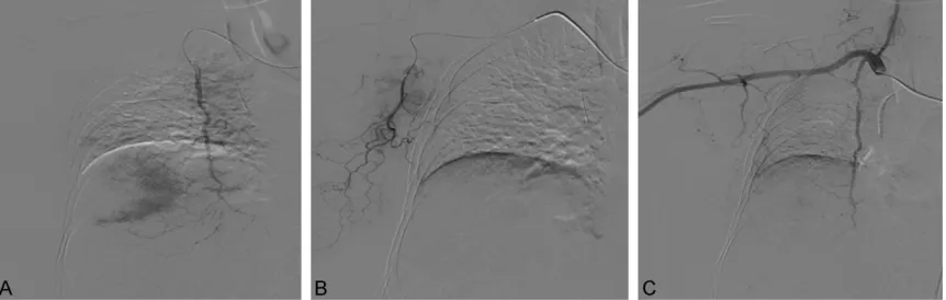 Figure 1. A: Blood vessels in breast cancer and breast cancer in parenchymal phase in angiography of right internal mammary artery; B: Irregular axillary lymph nodes in angiography of right lateral thoracic artery; C: Absence of blood supply to the breast cancer after embolism in angiography of internal mammary artery and lateral thoracic artery.