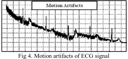 Fig 3. Baseline drifts in ECG signal 