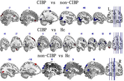 Figure 1. Significant differences in ALFF among patients with cancer-induced bone pain (CIBP), patients without cancer-induced bone pain (non-CIBP), and healthy controls (Hc)
