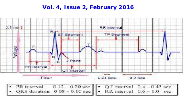 Figure 1: An ECG Signal with intervals 