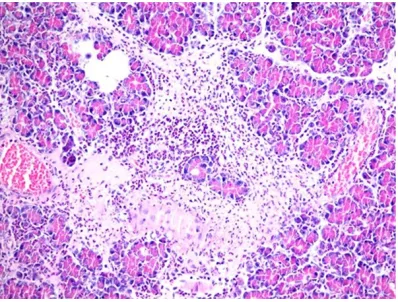 Figure 3. Hematoxylin-eosin (H-E) staining (400×). Microscopic appearance. Significant leukocyte infil-tration, edema, focal fat necrosis, aciner necrosis  is apparent (H&E ×400).