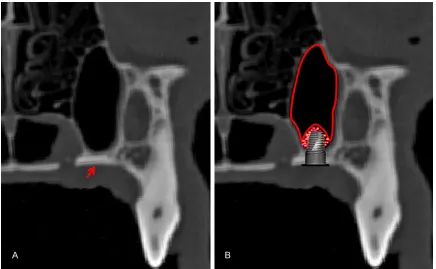 Figure 1. The section for maxillary sinus floor elevation in beagle model: A. The section located on the palatal side of the first maxillary molar distal cusp is selected as the surgical approach